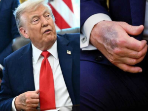 Trump reveals the secret behind his bruises and affirms: My mental abilities are excellent