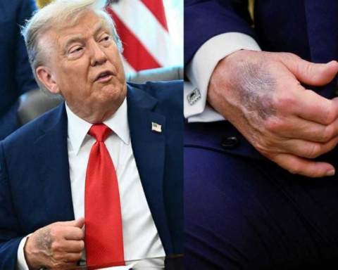 Trump reveals the secret behind his bruises and affirms: My mental abilities are excellent