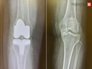 Al-Diriyah Hospital successfully rehabilitates a patient after joint replacement surgery