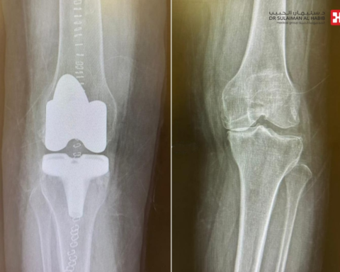 مستشفى الدرعية ينجح في تأهيل مريض بعد زراعة المفصل