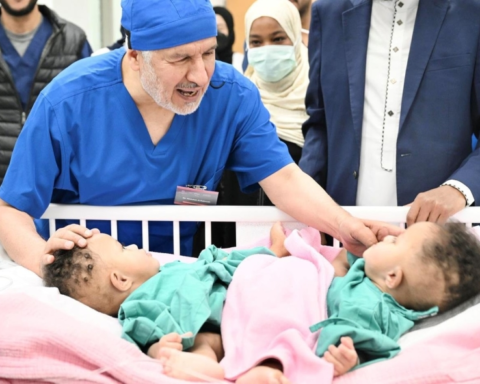 نجاح عملية فصل التوأم الصومالي رملا ورحمة في السعودية