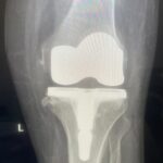 مستشفى القطيف المركزي يطلق وحدة المفاصل وينجز 30 جراحة