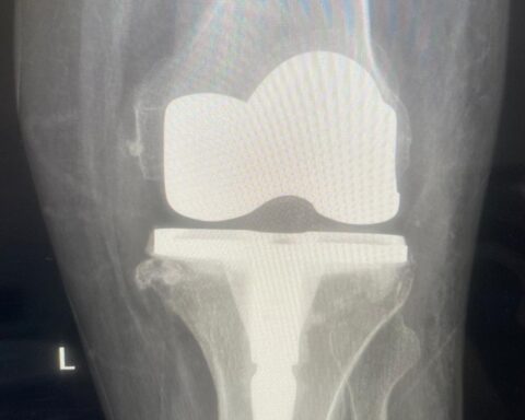 مستشفى القطيف المركزي يطلق وحدة المفاصل وينجز 30 جراحة