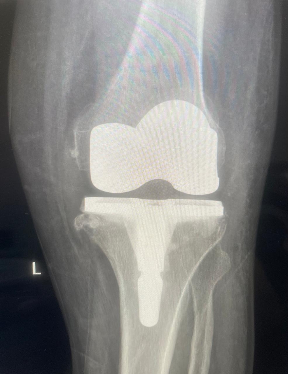 مستشفى القطيف المركزي يطلق وحدة المفاصل وينجز 30 جراحة