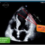 نجاح جراحة قلب نادرة لمريض سبعيني بمدينة الملك سعود الطبية
