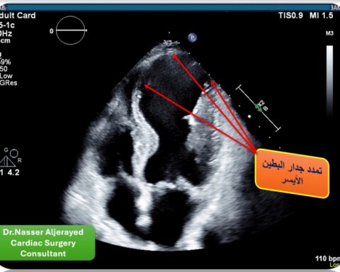 نجاح جراحة قلب نادرة لمريض سبعيني بمدينة الملك سعود الطبية