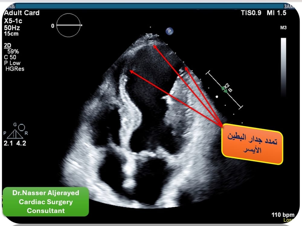 نجاح جراحة قلب نادرة لمريض سبعيني بمدينة الملك سعود الطبية